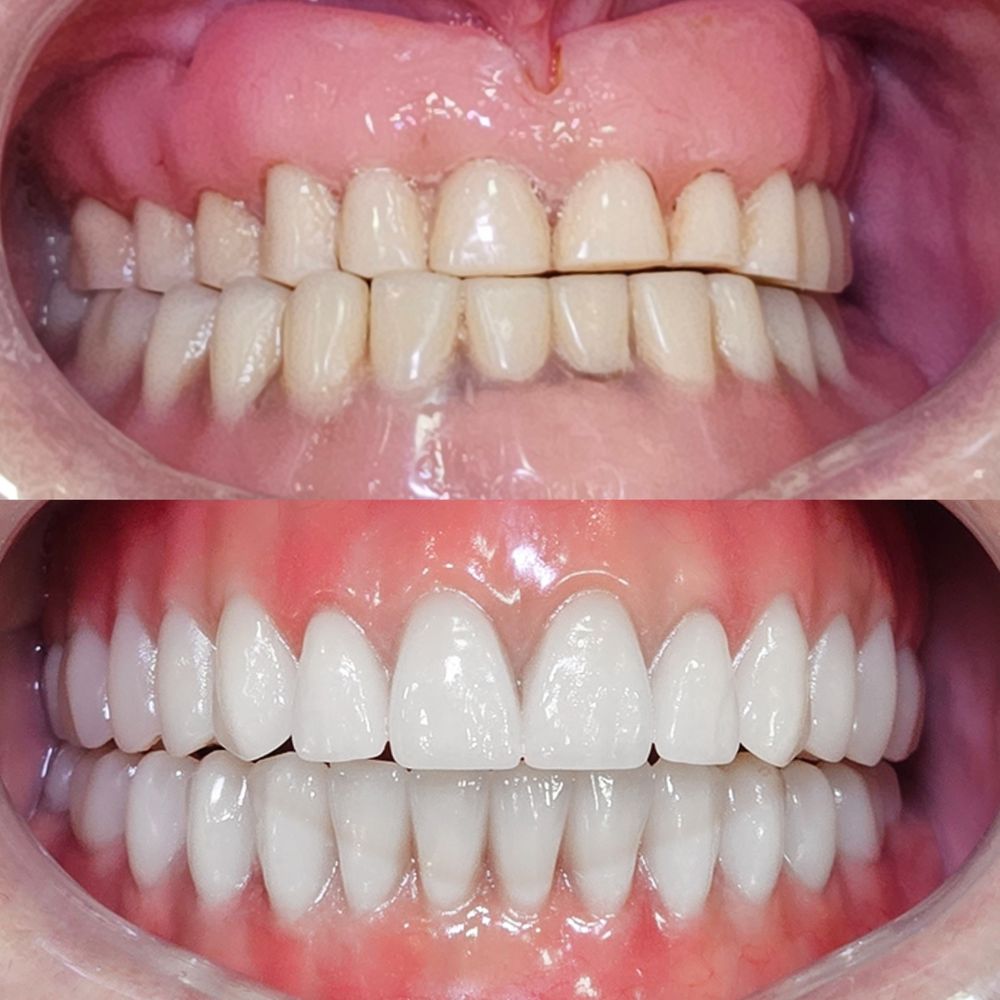 Resultado de reabilitação oral com implantes dentários na Figuière Clinique em Santo André
