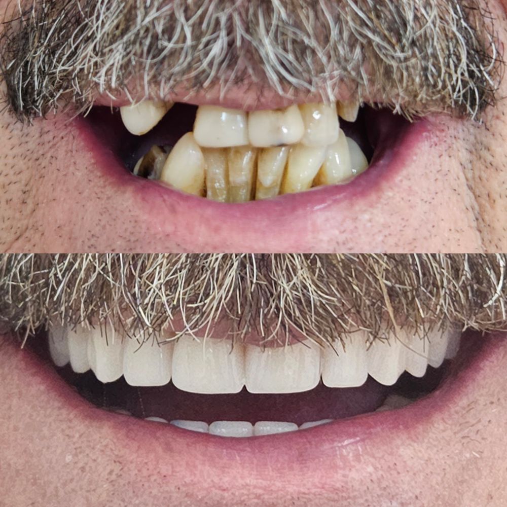 Caso de reabilitação com implantes dentários em Santo André — Antes e Depois Figuière Clinique