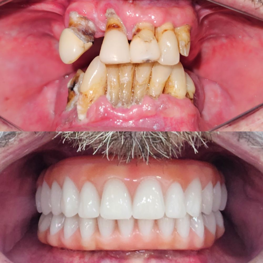Transformação do sorriso com implante dentário de alto padrão na Figuière Clinique em Santo André